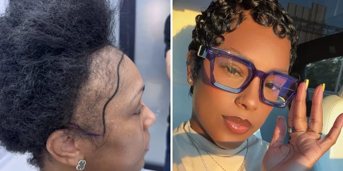 I couldn't afford a $13,000 hair transplant in the US. So I flew to Turkey and I love the results.