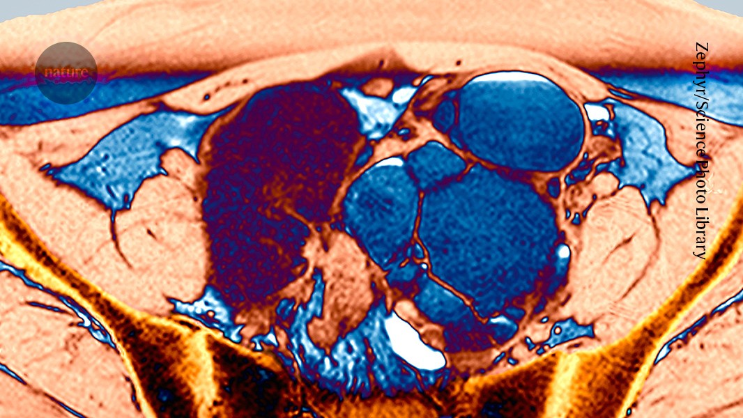 The 'missed disease' that affects 190 million: endometriosis drug shows early promise