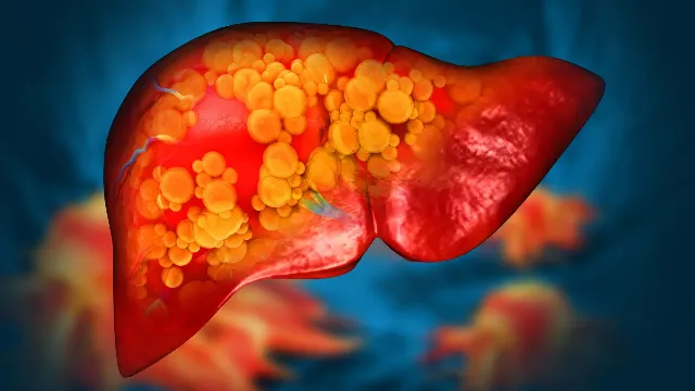 Texas A&M Links 1-Third-of-Global Plastic to Fatty Liver Disease